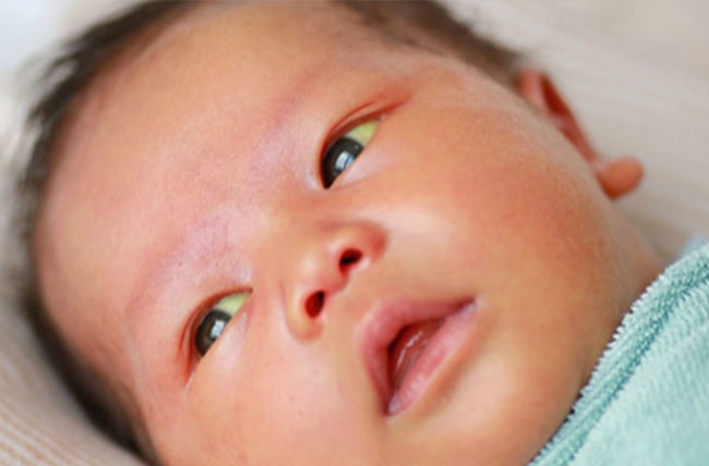 درباره زردی نوزاد چه میدانید؟