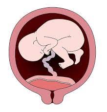 جفت سر راهی در بارداری