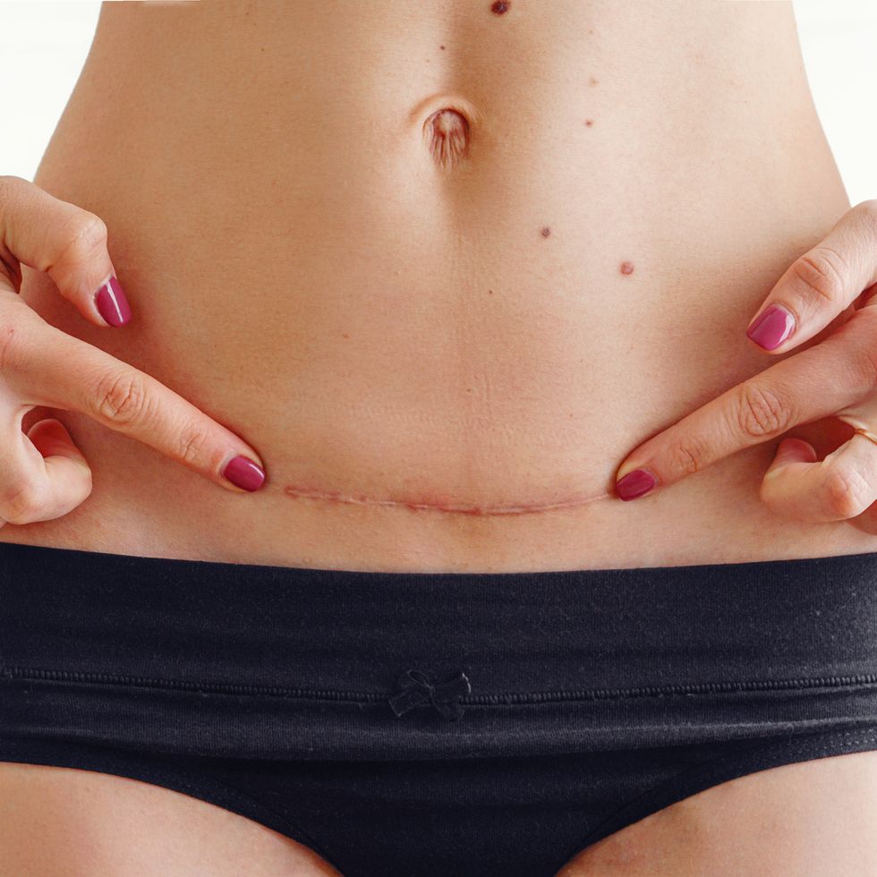 اسکار سزارین چیست؟