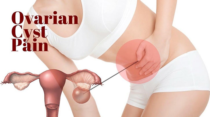 انواع کیست و توده های تخمدانی