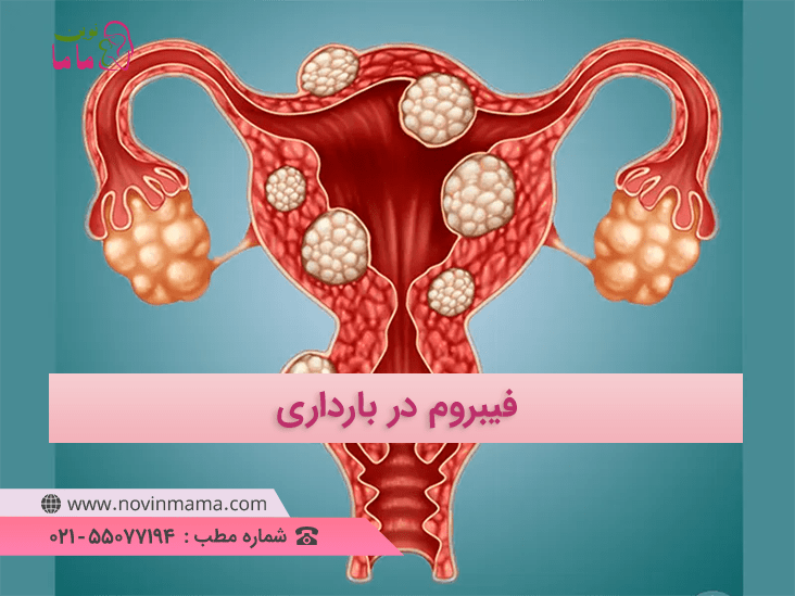 فیبروم در بارداری چیست و چه خطراتی دارد؟