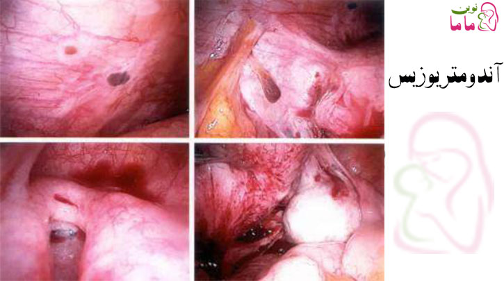 آندومتریوز