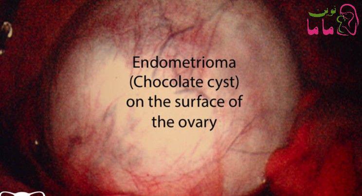 آیا کیست هموراژیک (خونی) تخمدان خطرناک است؟