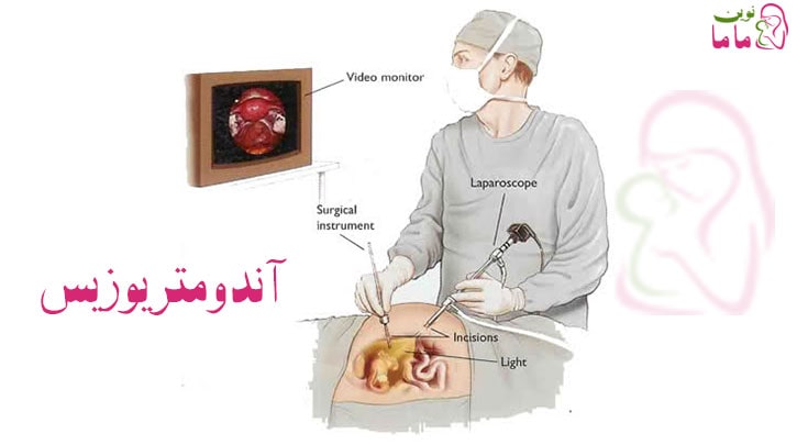 همه چیز درباره آندومتریوزیس