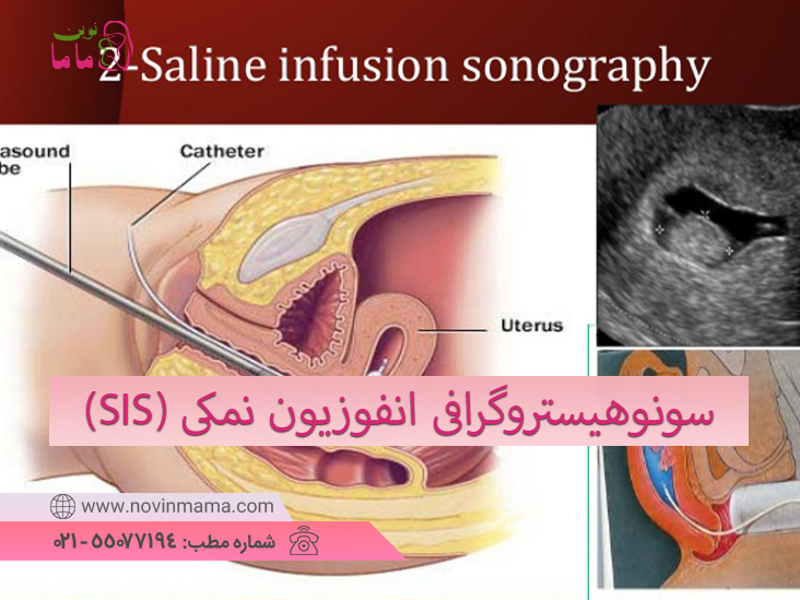 سونوهیستروگرافی انفوزیون نمکی (SIS) چیست؟