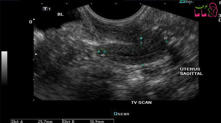 هیپوپلازی رحم و تاثیر آن بر ناباروری زنان