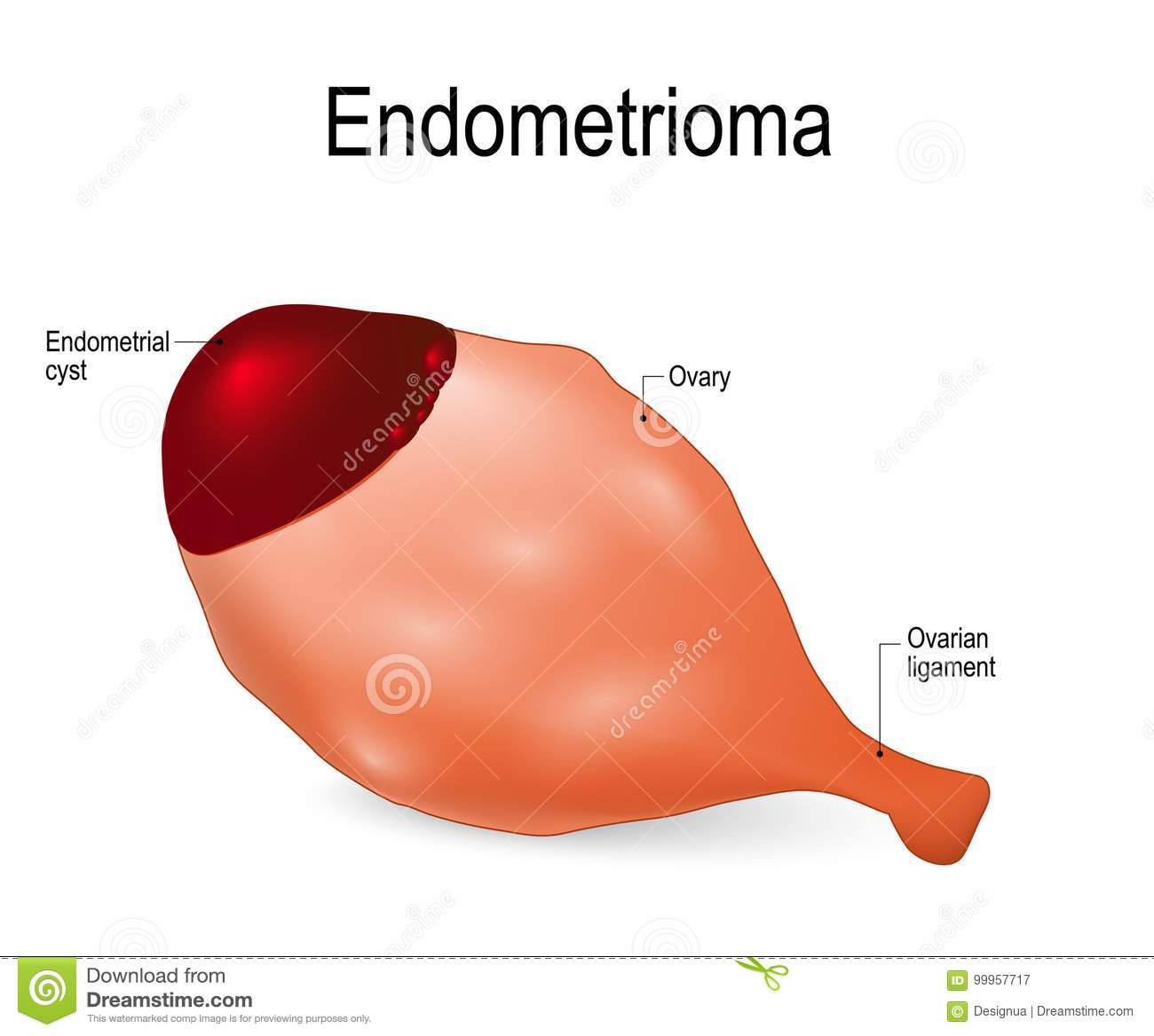 کیست های اندومتریوئید یا آندومتریومای تخمدان 