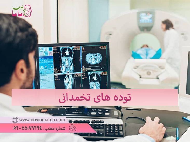 توده های تخمدانی وگزارش یک مورد کیس از آن