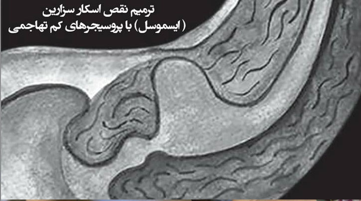 ترمیم نقص اسکار سزارین (ایسموسل) با پروسیجرهای کم تهاجمی