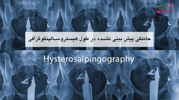 حاملگی پیش بینی نشده در طول هیستروسالپنگوگرافی