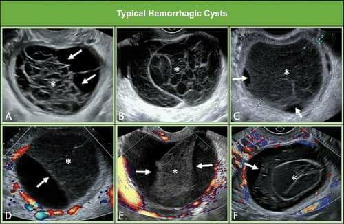 گزارش سونوگرافی توده تخمدانی براساس سیستم طبقه بندی شاخص ها  