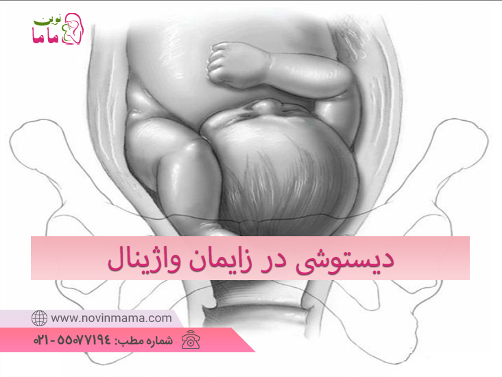 دیستوشی در زایمان واژینال