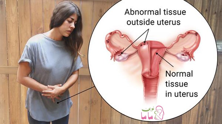 زنان مبتلا به آندومتریوز نابارور می شوند، آندومتریوزیس چیست؟
