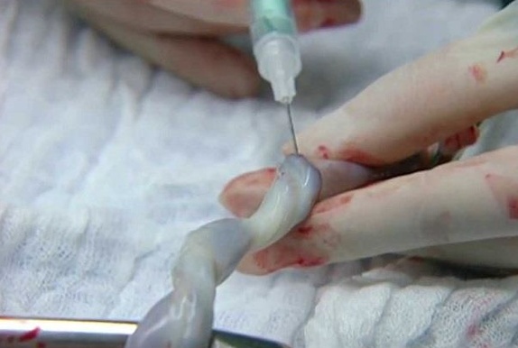 گازهای خون بندناف( ABG)