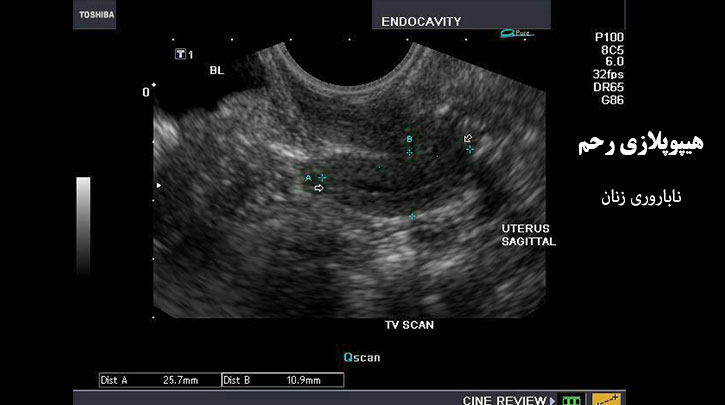 هیپوپلازی رحم در ناباروری زنان