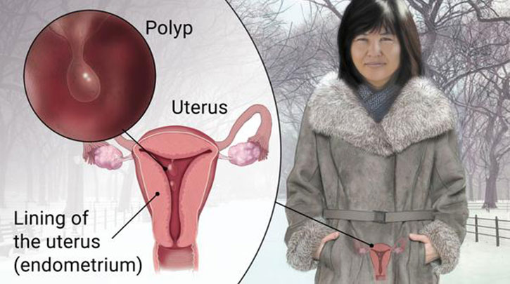 پولیپ های اندومتر
