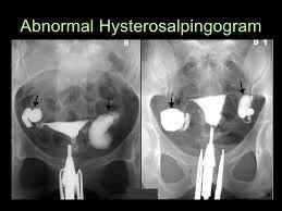 پزشک احتمالا بعد از دوره قاعدگی عکس رنگی رحم را انجام خواهد داد،