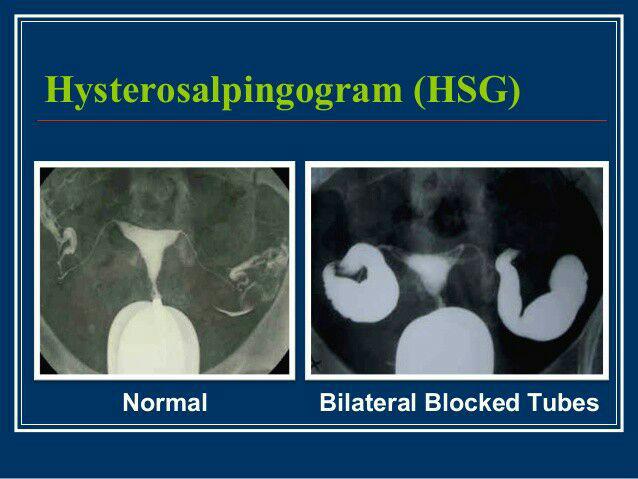 اگر لوله های فالوپ شما مسدود شده باشند، اسپرم قادر به رسیدن به تخمک نخواهد بود و یا تخمک بارور نمی تواند به رحم برسد.